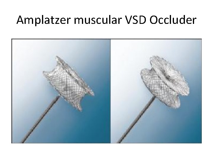 Amplatzer muscular VSD Occluder 