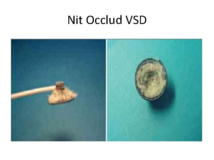 Nit Occlud VSD 