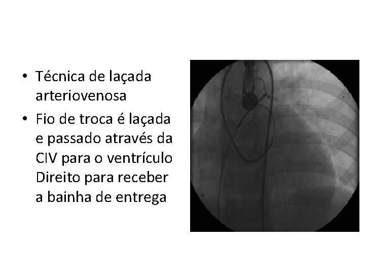  • Técnica de laçada arteriovenosa • Fio de troca é laçada e passado