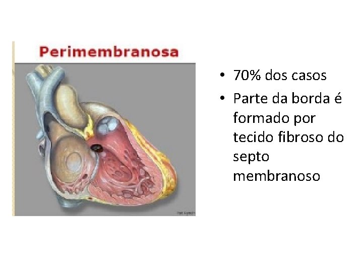  • 70% dos casos • Parte da borda é formado por tecido fibroso