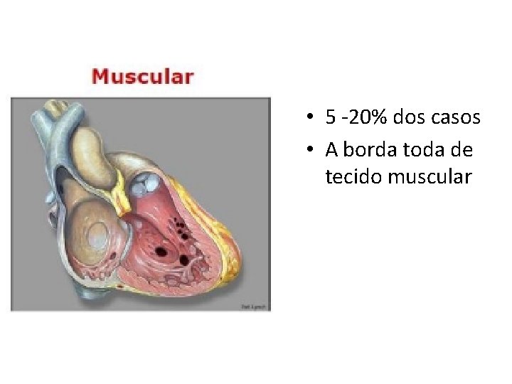  • 5 -20% dos casos • A borda toda de tecido muscular 