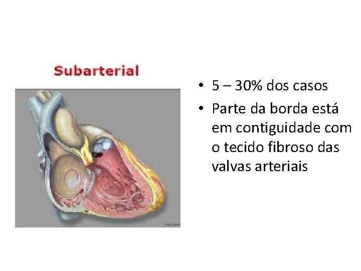  • 5 – 30% dos casos • Parte da borda está em contiguidade