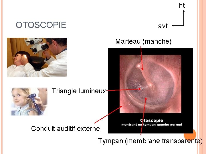 ht OTOSCOPIE avt Marteau (manche) Triangle lumineux Conduit auditif externe Tympan (membrane transparente) 