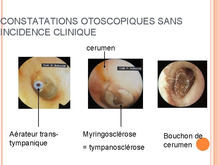 CONSTATATIONS OTOSCOPIQUES SANS INCIDENCE CLINIQUE cerumen Aérateur transtympanique Myringosclérose = tympanosclérose Bouchon de cerumen