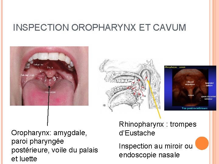 INSPECTION OROPHARYNX ET CAVUM Oropharynx: amygdale, paroi pharyngée postérieure, voile du palais et luette