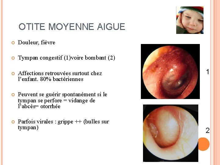 OTITE MOYENNE AIGUE Douleur, fièvre Tympan congestif (1)voire bombant (2) Affections retrouvées surtout chez