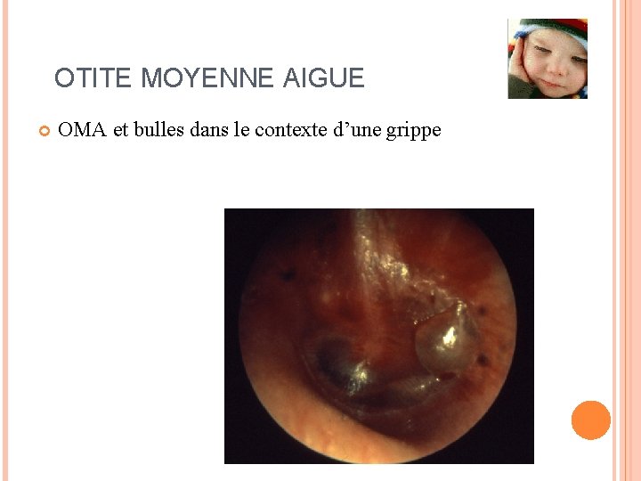 OTITE MOYENNE AIGUE OMA et bulles dans le contexte d’une grippe 