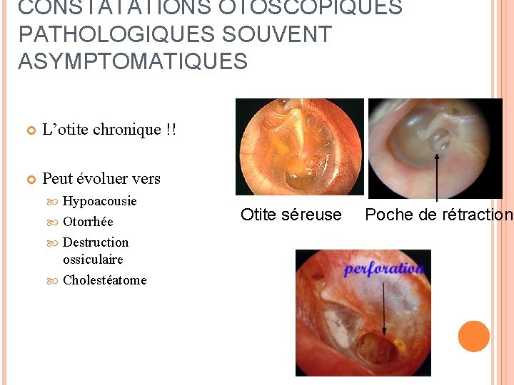 CONSTATATIONS OTOSCOPIQUES PATHOLOGIQUES SOUVENT ASYMPTOMATIQUES L’otite chronique !! Peut évoluer vers Hypoacousie Otorrhée Destruction