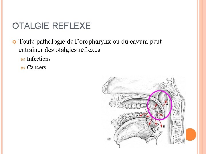 OTALGIE REFLEXE Toute pathologie de l’oropharynx ou du cavum peut entraîner des otalgies réflexes