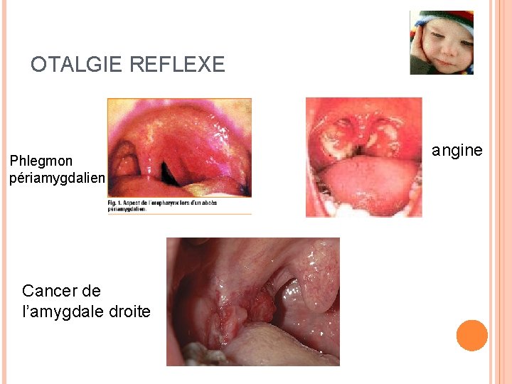 OTALGIE REFLEXE Phlegmon périamygdalien Cancer de l’amygdale droite angine 