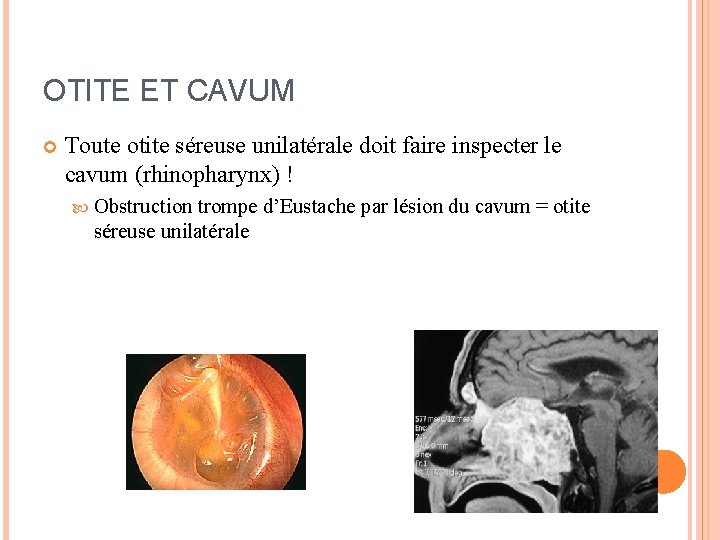 OTITE ET CAVUM Toute otite séreuse unilatérale doit faire inspecter le cavum (rhinopharynx) !