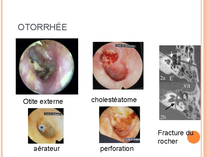 OTORRHÉE Otite externe aérateur cholestéatome perforation Fracture du rocher 