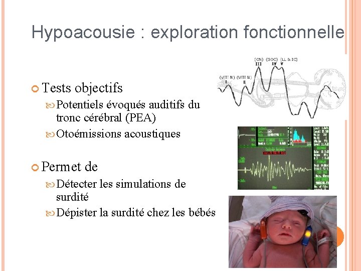 Hypoacousie : exploration fonctionnelle Tests objectifs Potentiels évoqués auditifs du tronc cérébral (PEA) Otoémissions