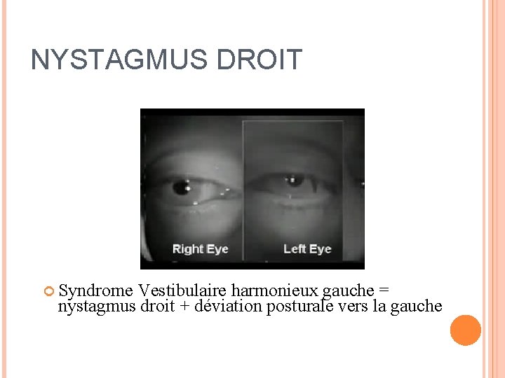 NYSTAGMUS DROIT Syndrome Vestibulaire harmonieux gauche = nystagmus droit + déviation posturale vers la