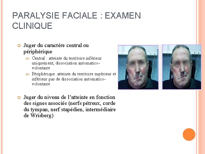 PARALYSIE FACIALE : EXAMEN CLINIQUE Juger du caractère central ou périphérique Central : atteinte