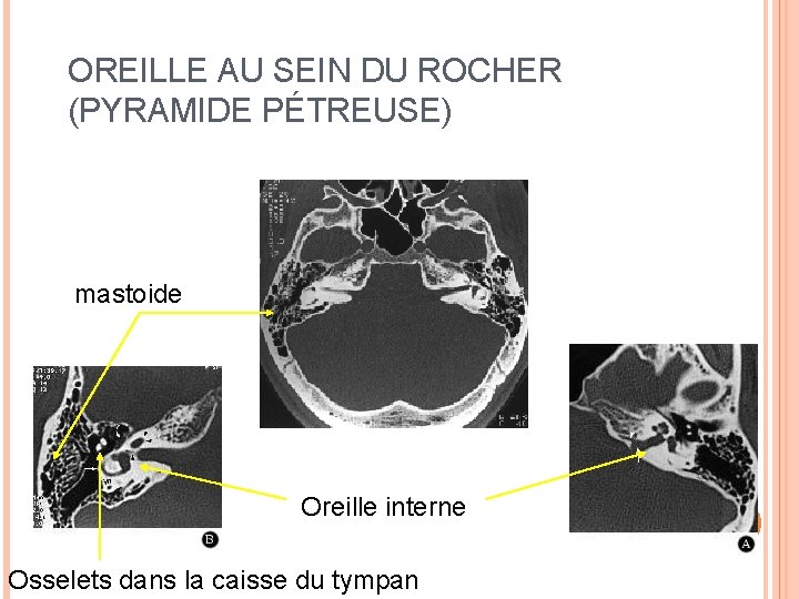 OREILLE AU SEIN DU ROCHER (PYRAMIDE PÉTREUSE) mastoide Oreille interne Osselets dans la caisse