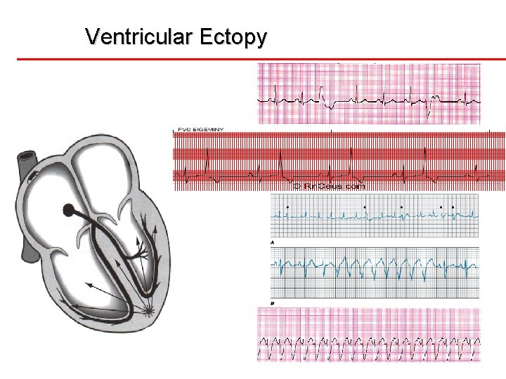 Ventricular Ectopy 10 