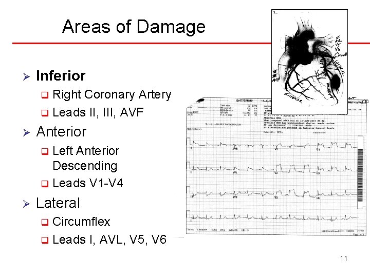 Areas of Damage Ø Inferior Right Coronary Artery q Leads II, III, AVF q