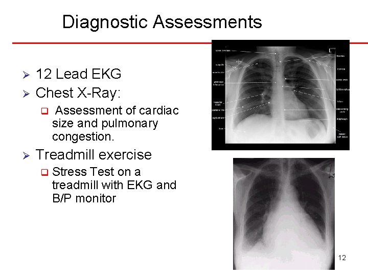 Diagnostic Assessments Ø Ø 12 Lead EKG Chest X-Ray: q Ø Assessment of cardiac