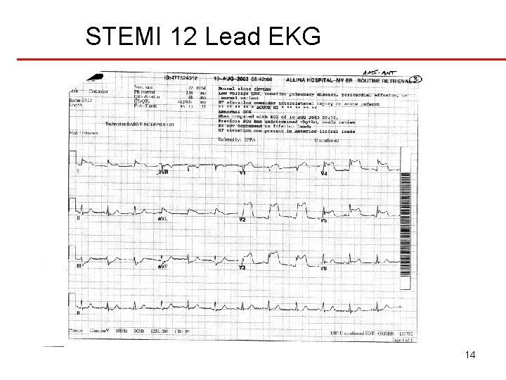 STEMI 12 Lead EKG 14 