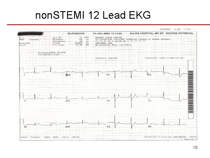 non. STEMI 12 Lead EKG 15 