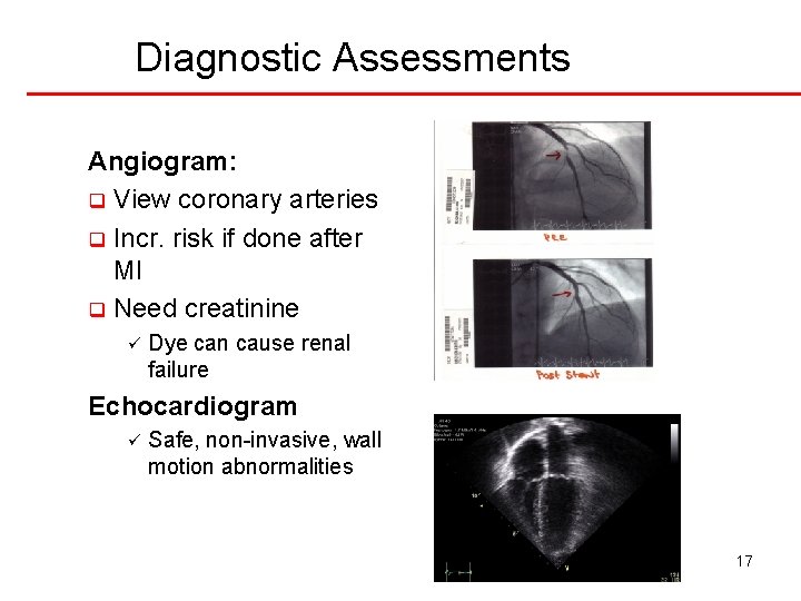 Diagnostic Assessments Angiogram: q View coronary arteries q Incr. risk if done after MI