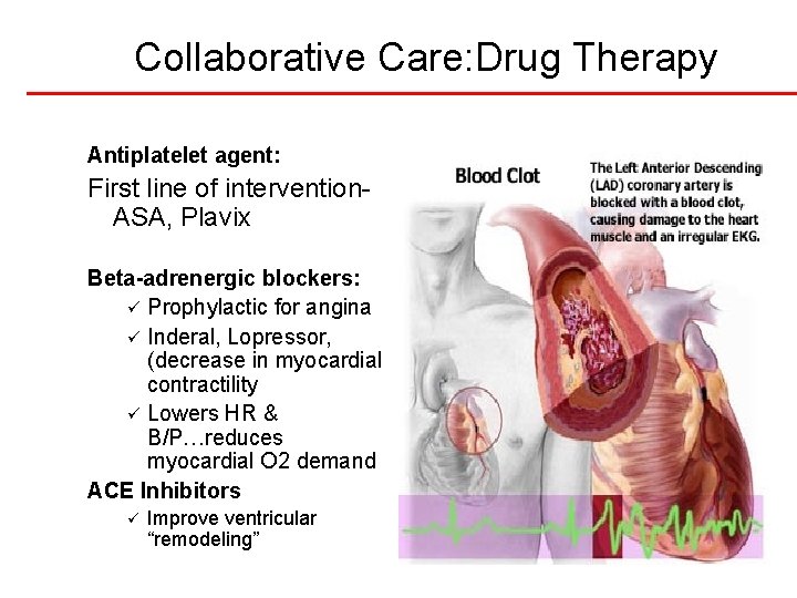 Collaborative Care: Drug Therapy Antiplatelet agent: First line of intervention. ASA, Plavix Beta-adrenergic blockers: