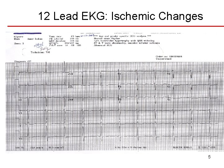 12 Lead EKG: Ischemic Changes 5 