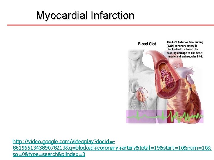 Myocardial Infarction http: //video. google. com/videoplay? docid=861965134389078213&q=blocked+coronary+artery&total=19&start=10&num=10& 7 so=0&type=search&plindex=3 