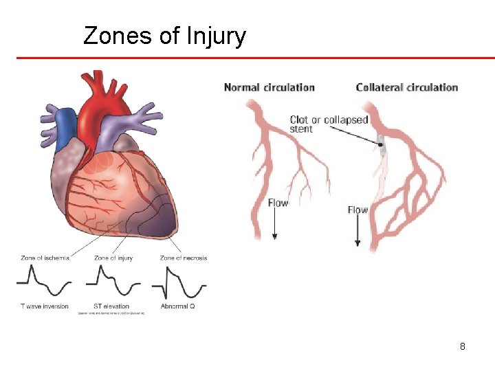 Zones of Injury 8 