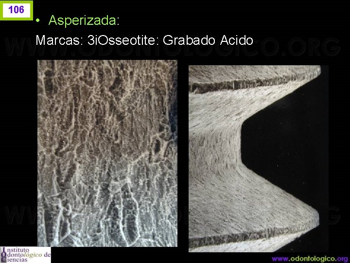 106 • Asperizada: Marcas: 3 i. Osseotite: Grabado Acido 