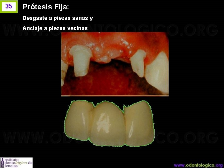 35 Prótesis Fija: Desgaste a piezas sanas y Anclaje a piezas vecinas 