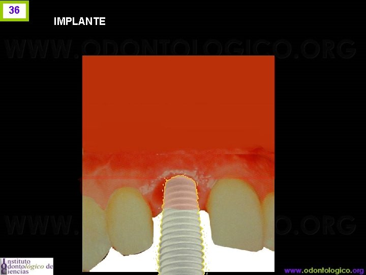 36 IMPLANTE 