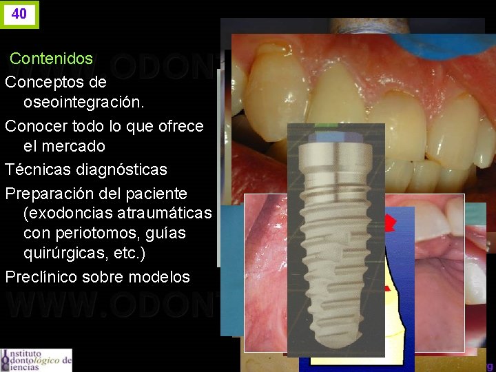 40 Contenidos Conceptos de oseointegración. Conocer todo lo que ofrece el mercado Técnicas diagnósticas