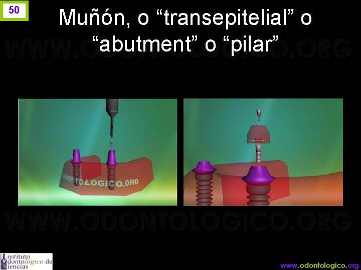 50 J. I. H. Muñón, o “transepitelial” o “abutment” o “pilar” 