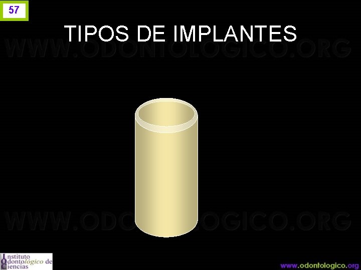 57 TIPOS DE IMPLANTES 