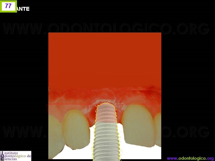 77 IMPLANTE 