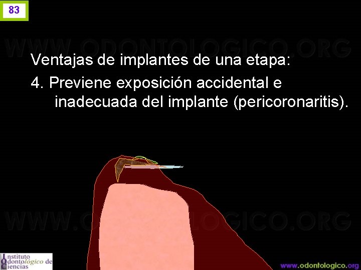 83 Ventajas de implantes de una etapa: 4. Previene exposición accidental e inadecuada del