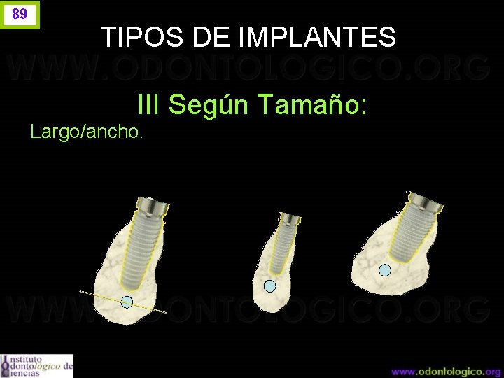 89 TIPOS DE IMPLANTES III Según Tamaño: Largo/ancho. 