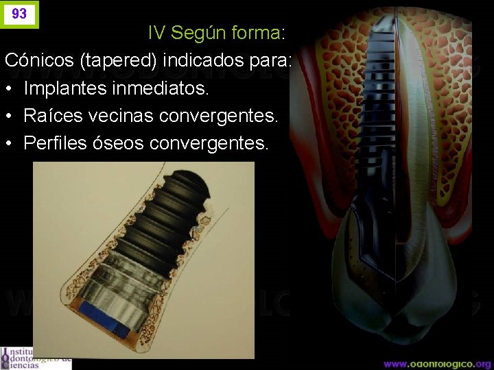 93 IV Según forma: Cónicos (tapered) indicados para: • Implantes inmediatos. • Raíces vecinas