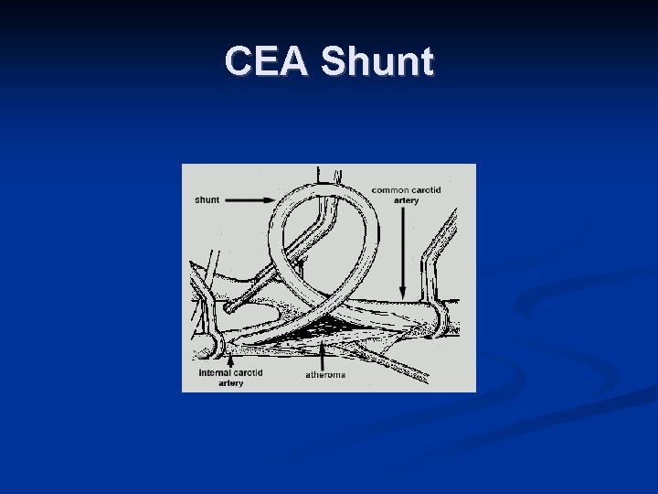 CEA Shunt 