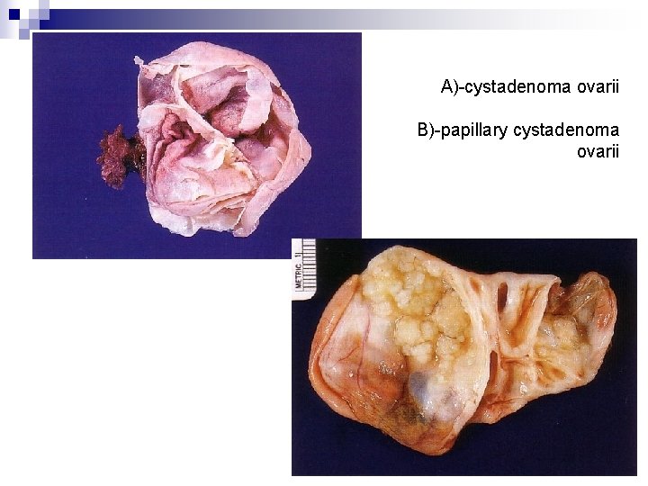 A)-cystadenoma ovarii B)-papillary cystadenoma ovarii 
