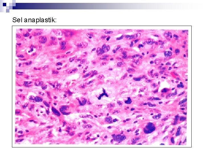 Sel anaplastik: 