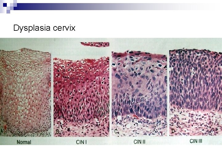 Dysplasia cervix 