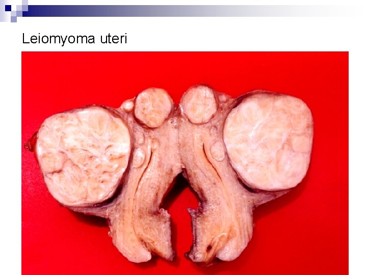 Leiomyoma uteri 