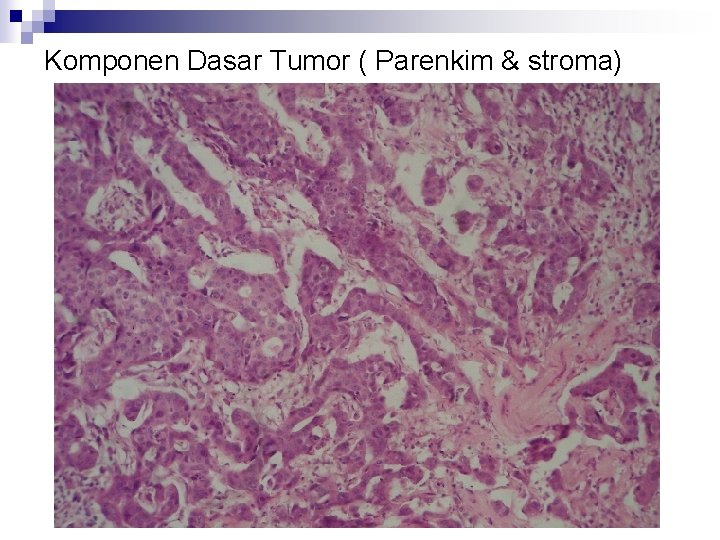 Komponen Dasar Tumor ( Parenkim & stroma) 