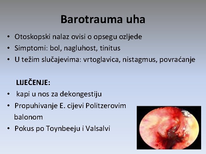 Barotrauma uha • Otoskopski nalaz ovisi o opsegu ozljede • Simptomi: bol, nagluhost, tinitus Barotrauma uha • Otoskopski nalaz ovisi o opsegu ozljede • Simptomi: bol, nagluhost, tinitus
