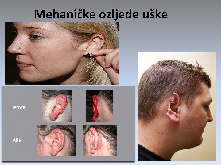 Mehaničke ozljede uške 