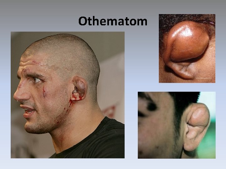 Othematom 
