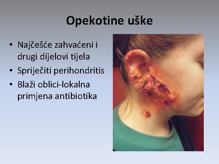 Opekotine uške • Najčešće zahvaćeni i drugi dijelovi tijela • Spriječiti perihondritis • Blaži Opekotine uške • Najčešće zahvaćeni i drugi dijelovi tijela • Spriječiti perihondritis • Blaži